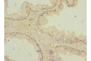 Immunohistochemistry of paraffin-embedded human prostate cancer using ABIN7176633 at dilution of 1:100 (ZIC3 Antikörper  (AA 1-240))