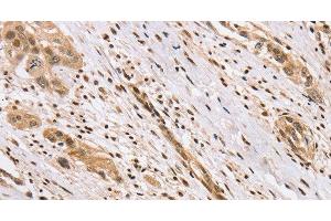 Immunohistochemistry of paraffin-embedded Human esophagus cancer using CENPV Polyclonal Antibody at dilution of 1:40 (CENPV Antikörper)