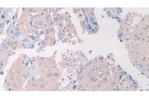 Detection of FLII in Human Breast cancer Tissue using Polyclonal Antibody to Flightless I Homolog (FLII) (FLII Antikörper  (AA 896-1176))