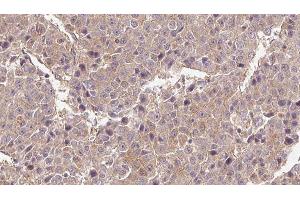 ABIN6276562 at 1/100 staining Human liver cancer tissue by IHC-P. (Glutamate Receptor 3 Antikörper)