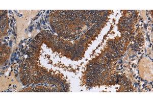 Immunohistochemistry of paraffin-embedded Human colon cancer tissue using LRRC57 Polyclonal Antibody at dilution 1:40 (LRRC57 Antikörper)