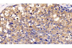 Detection of CTSK in Human Breast cancer Tissue using Polyclonal Antibody to Cathepsin K (CTSK) (Cathepsin K Antikörper  (AA 71-319))