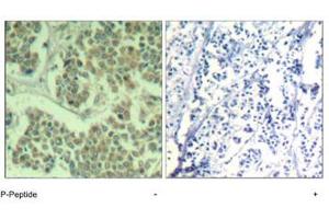 Immunohistochemical analysis of paraffin-embedded human breast carcinoma tissue using EIF2S1 (phospho S49) polyclonal antibody . (EIF2S1 Antikörper  (pSer49))