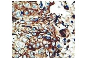 IHC testing of FFPE human breast cancer with PACSIN2 antibody at 1:50.