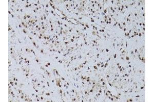 Immunohistochemistry of paraffin-embedded human uterine cancer using HUS1 antibody (ABIN6131776, ABIN6142084, ABIN6142086 and ABIN6218116) at dilution of 1:100 (40x lens). (HUS1 Antikörper  (AA 1-280))