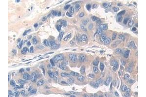 Detection of DOK3 in Human Breast cancer Tissue using Polyclonal Antibody to Docking Protein 3 (DOK3) (DOK3 Antikörper  (AA 128-385))