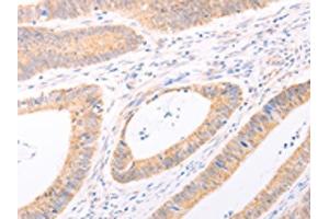 The image on the left is immunohistochemistry of paraffin-embedded Human colon cancer tissue using ABIN7131482(TRIM32 Antibody) at dilution 1/40, on the right is treated with fusion protein. (TRIM32 Antikörper)
