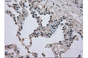 Immunohistochemical staining of paraffin-embedded Adenocarcinoma of breast tissue using anti-DHFR mouse monoclonal antibody. (Dihydrofolate Reductase Antikörper)