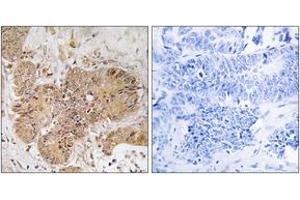 Immunohistochemistry analysis of paraffin-embedded human colon carcinoma tissue, using LUC7L2 Antibody. (LUC7L2 Antikörper  (AA 129-178))