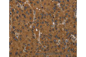 Immunohistochemistry of Human liver cancer using MIER2 Polyclonal Antibody at dilution of 1:60 (MIER2 Antikörper)