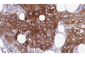 ABIN6277789 at 1/100 staining Human Head and neck cancer tissue by IHC-P. (SIX2 Antikörper  (Internal Region))
