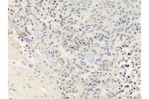 ABIN6259340 and ABIN6275456 at 1/100 staining human Hodgkin lymphoma by IHC-P. (RRAGA/B Antikörper  (C-Term))