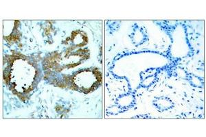 Immunohistochemical analysis of paraffin-embedded human breast carcinoma tissue using PAK1/PAK2/PAK3(Phospho-Thr423/Thr402/Thr421) Antibody(left) or the same antibody preincubated with blocking peptide(right). (PAK1/2/3 Antikörper  (pThr423))