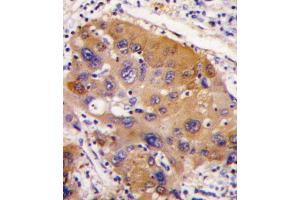 Formalin-fixed and paraffin-embedded human hepatocarcinoma tissue reacted with NNMT antibody , which was peroxidase-conjugated to the secondary antibody, followed by DAB staining. (NNMT Antikörper  (AA 77-106))