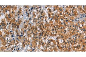 Immunohistochemistry of paraffin-embedded Human thyroid cancer using SMAD9 Polyclonal Antibody at dilution of 1:30 (SMAD9 Antikörper)