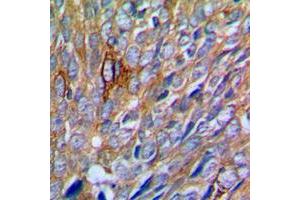 Immunohistochemical analysis of PAK1 staining in human prostate cancer formalin fixed paraffin embedded tissue section. (PAK1 Antikörper  (Center))