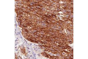 Immunohistochemical staining (Formalin-fixed paraffin-embedded sections) of human melanoma with STX7 monoclonal antibody, clone CL0257  shows strong cytoplasmic and membrane positivity in tumor cells. (Syntaxin 7 Antikörper)