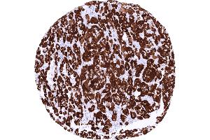 Adrenocortical carcinoma showing strong STAR immunostaining of tumor cells (Rekombinanter STAR Antikörper)