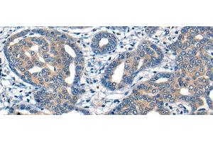 Immunohistochemistry of paraffin-embedded Human liver cancer tissue using MIIP Polyclonal Antibody at dilution of 1:45(x200) (MIIP Antikörper)