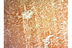 Formalin-fixed, paraffin-embedded human Hepatocellular Carcinoma (HCC) stained with Glypican-3 Monoclonal Antibody (1G12) (Glypican 3 Antikörper  (AA 511-580))