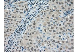 Immunohistochemical staining of paraffin-embedded Adenocarcinoma of colon tissue using anti-LDHAmouse monoclonal antibody. (Lactate Dehydrogenase A Antikörper)