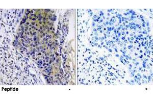 Immunohistochemistry analysis of paraffin-embedded human lung carcinoma tissue using MRPL34 polyclonal antibody . (MRPL34 Antikörper)
