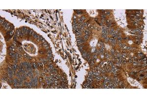 Immunohistochemistry of paraffin-embedded Human colon cancer tissue using MAGEC2 Polyclonal Antibody at dilution 1:40 (MAGEC2 Antikörper)