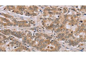 Immunohistochemistry of paraffin-embedded Human liver cancer tissue using CLEC16A Polyclonal Antibody at dilution 1:45 (CLEC16A Antikörper)