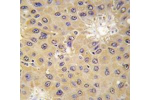 IHC analysis of FFPE human hepatocarcinoma tissue stained with ACAT1 antibody (ACAT1 Antikörper  (AA 296-329))