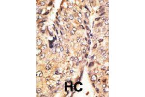 Formalin-fixed and paraffin-embedded human cancer tissue reacted with GDF10 polyclonal antibody  , which was peroxidase-conjugated to the secondary antibody, followed by DAB staining.