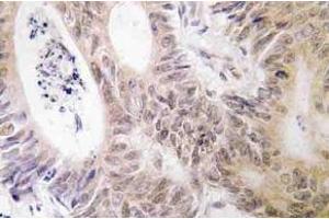 Immunohistochemistry (IHC) analyzes of MSK1 antibody in paraffin-embedded human colon carcinoma tissue. (MSK1 Antikörper)