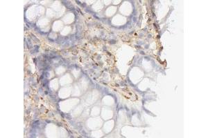 ABIN6266830 at 1/100 staining human colon cancer tissues sections by IHC-P. (COL4A1 Antikörper)
