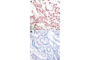 Immunohistochemical staining of human breast cancer tissue by NFKB2 (phospho S866) polyclonal antibody  without blocking peptide (A) or preincubated with blocking peptide (B) under 1:50-1:100 dilution.