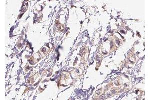 ABIN6276448 at 1/100 staining Human breast cancer tissue by IHC-P.