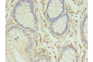 Immunohistochemistry of paraffin-embedded human colon cancer using ABIN7155609 at dilution of 1:100 (HLA-DRB4 Antikörper  (AA 30-227))