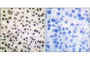 Immunohistochemistry analysis of paraffin-embedded human breast carcinoma, using MEF2A (Phospho-Ser408) Antibody. (MEF2A Antikörper  (pSer408))