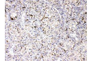 Apolipoprotein B was detected in paraffin-embedded sections of human liver cancer tissues using rabbit anti- Apolipoprotein B Antigen Affinity purified polyclonal antibody (Catalog # ) at 1 ? (APOB Antikörper  (AA 246-450))