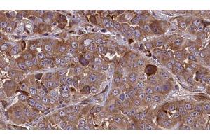 ABIN6273842 at 1/100 staining Human liver cancer tissue by IHC-P. (CMKLR1 Antikörper  (Internal Region))