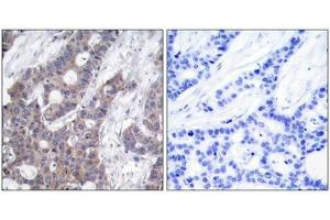 Immunohistochemical analysis of paraffin-embedded human breast carcinoma tissue using Stathmin 1(Phospho-Ser16) Antibody(left) or the same antibody preincubated with blocking peptide(right). (Stathmin 1 Antikörper  (pSer16))