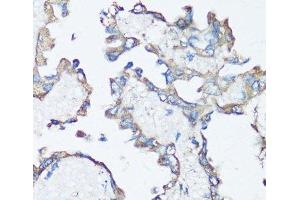 Immunohistochemistry of paraffin-embedded Human lung cancer using SRC Polyclonal Antibody at dilution of 1:100 (40x lens). (Src Antikörper)