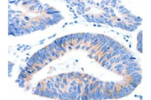 The image on the left is immunohistochemistry of paraffin-embedded Human colon cancer tissue using ABIN7191546(MUC3A Antibody) at dilution 1/60, on the right is treated with synthetic peptide. (MUC3A Antikörper)