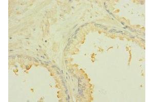 Immunohistochemistry of paraffin-embedded human prostate cancer using ABIN7168444 at dilution of 1:100 (ROBO2 Antikörper  (AA 450-660))