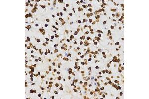 Immunohistochemistry of paraffin-embedded human liver cancer using DiMethyl-Histone H3-K27 antibody. (Histone 3 Antikörper  (H3K27me))