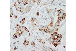 IHC-P: SKP2 antibody testing of human breast cancer tissue (SKP2 Antikörper  (N-Term))