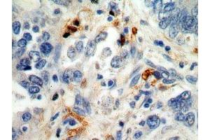 IHC analysis of paraffin-embedded human stomach cancer cells using S100A8 Antibody (dilution 1:100). (S100A8 Antikörper)