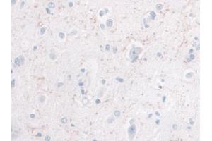 IHC-P analysis of Human Glioma Tissue, with DAB staining. (IL-10 Antikörper  (AA 1-178))