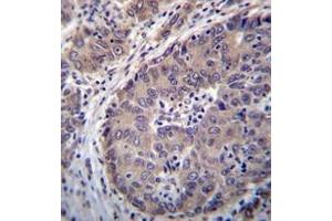 Immunohistochemistry analysis in formalin fixed and paraffin embedded human hepatocarcinoma reacted with PNLIPRP3 Antibody (N-term) followed which was peroxidase conjugated to the secondary antibody and followed byDAB staining. (PNLIPRP3 Antikörper  (N-Term))