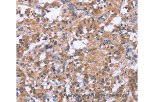 Immunohistochemistry of Human gastric cancer using SLC52A1 Polyclonal Antibody at dilution of 1:40 (GPR172B Antikörper)