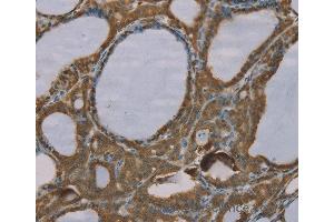 Immunohistochemistry of Human esophagus cancer using S100A6 Polyclonal Antibody at dilution of 1:35 (S100A6 Antikörper)