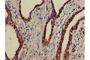 Immunohistochemistry of paraffin-embedded human prostate cancer using ABIN7145034 at dilution of 1:100